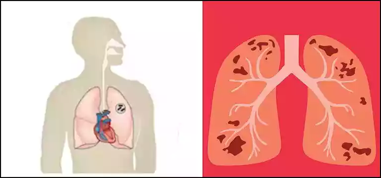  Active Tuberculosis Stage: Signs, Symptoms, Diagnosis, and Treatment